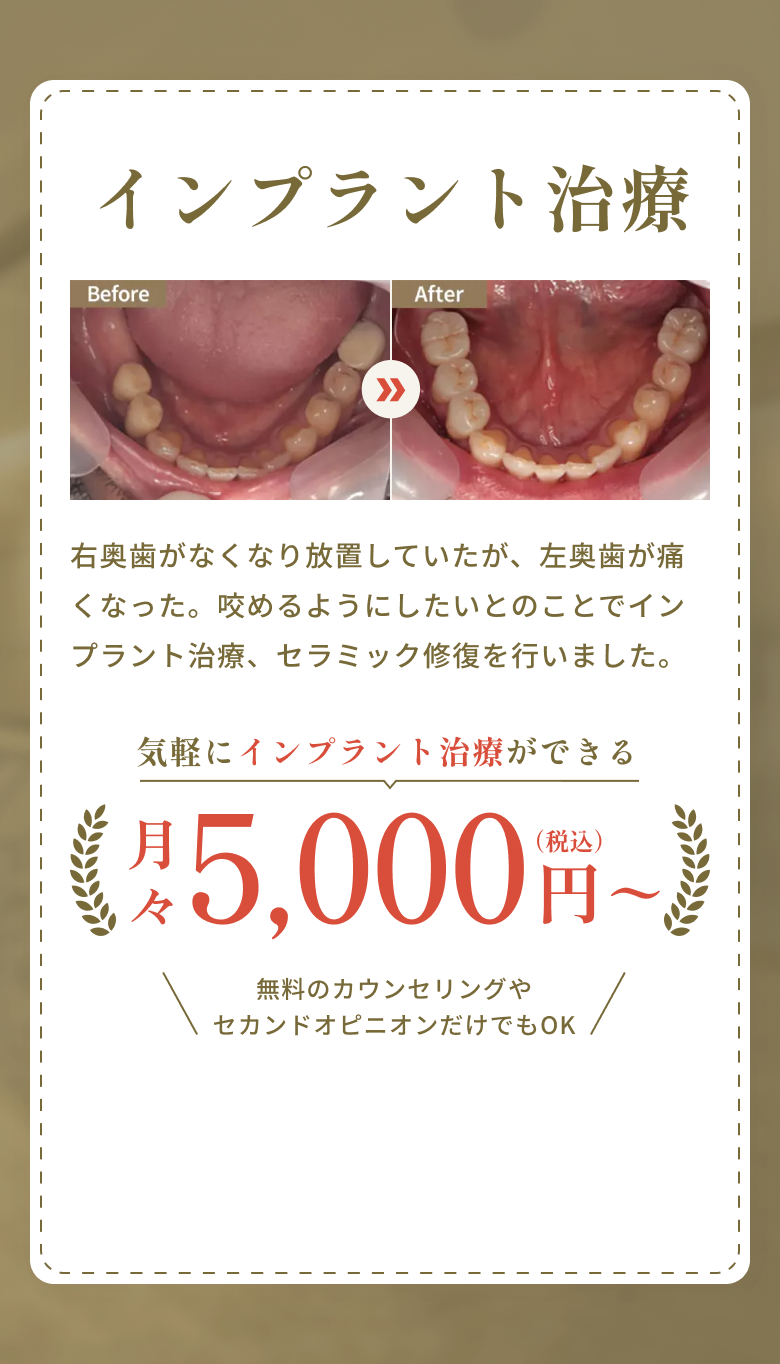 インプラント治療