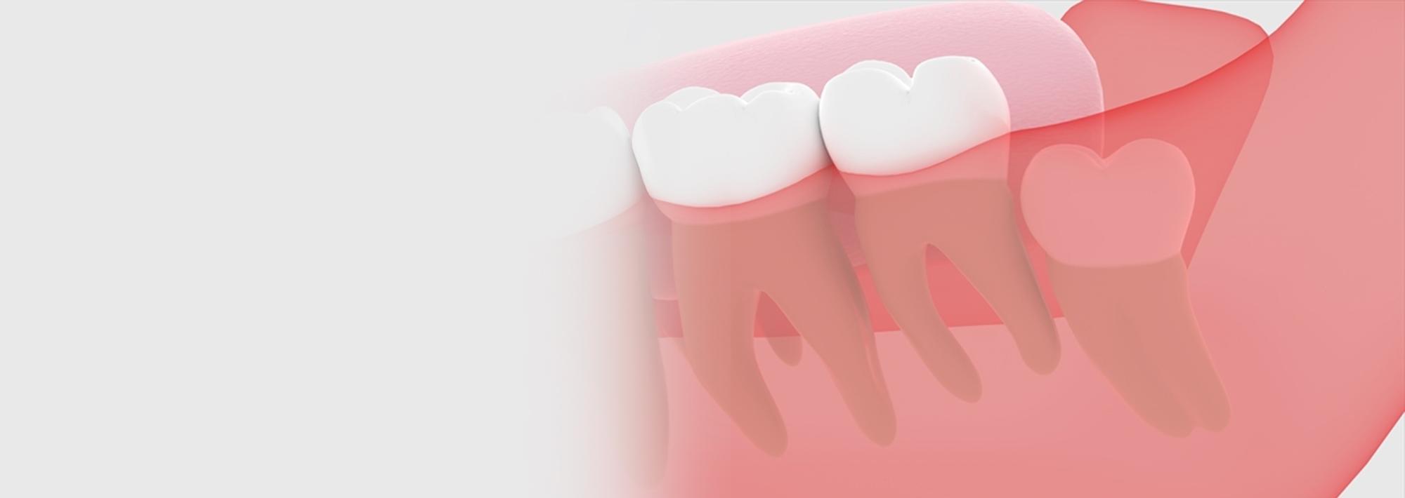 親知らずの抜歯